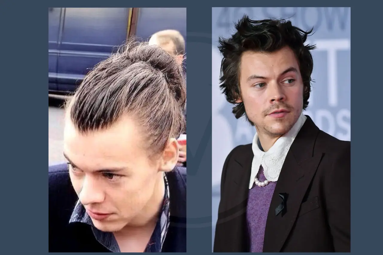 Harry Styles Before and After Hair Transplant