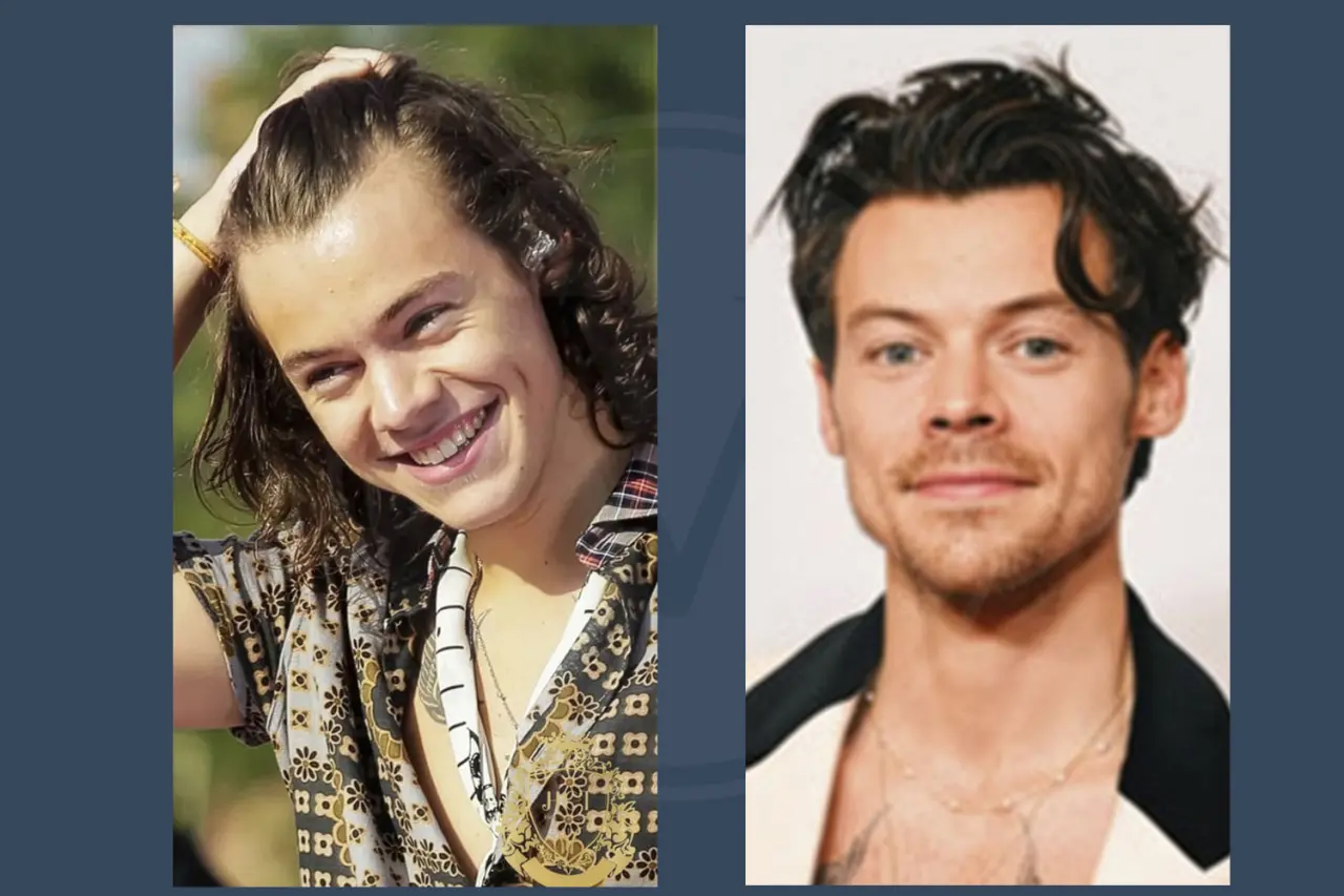 Harry Styles Before and After Hair Transplant