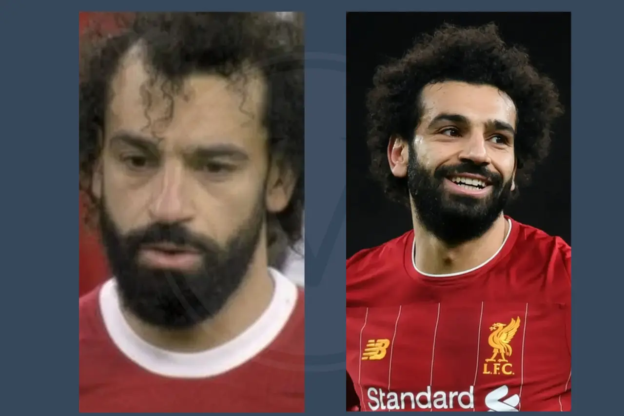 Mo Salah Before and After Hair Transplant