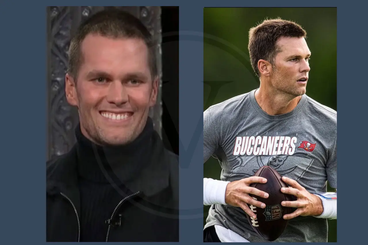 Tom Brady Before And After Hair Transplant