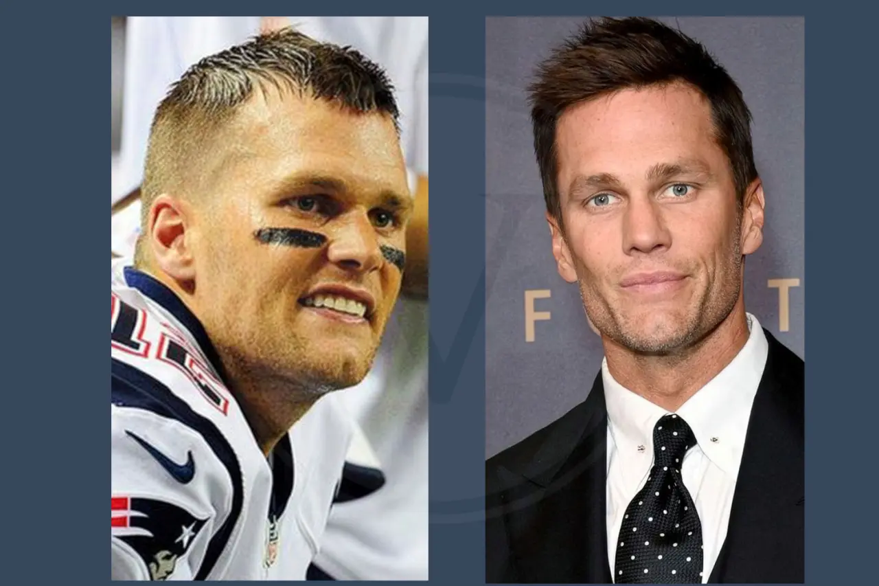 Tom Brady Before And After Hair Transplant