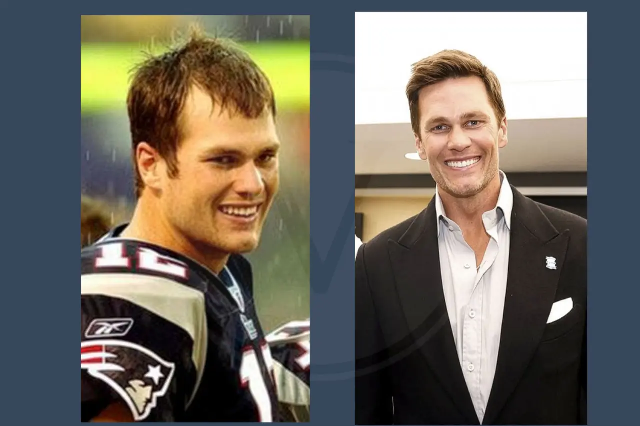 Tom Brady Before And After Hair Transplant