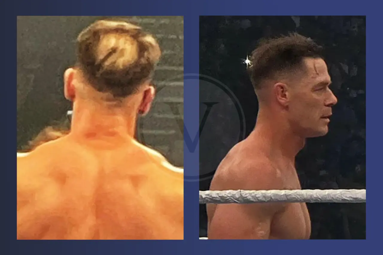 John Cena Before And After Hair Transplant