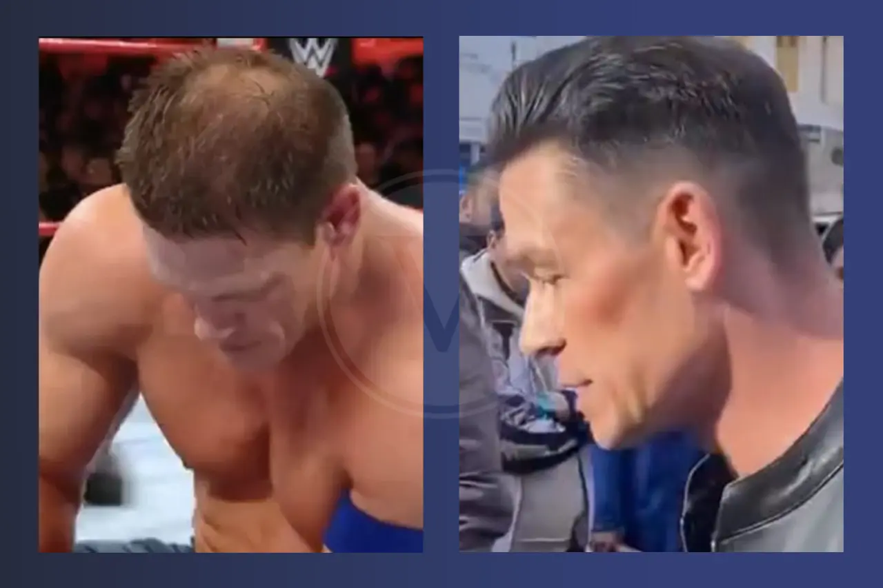 John Cena Before And After Hair Transplant