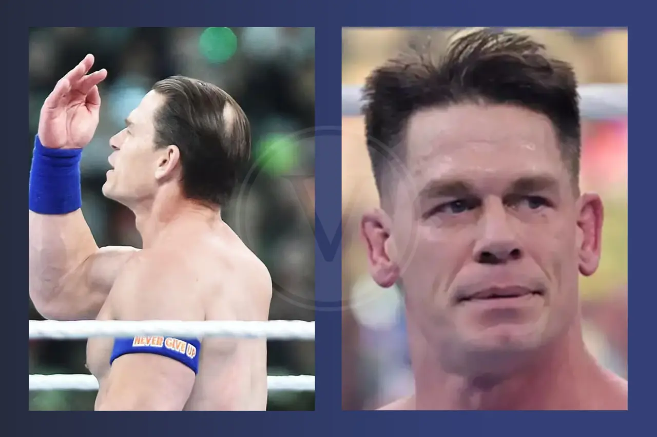 John Cena Before And After Hair Transplant