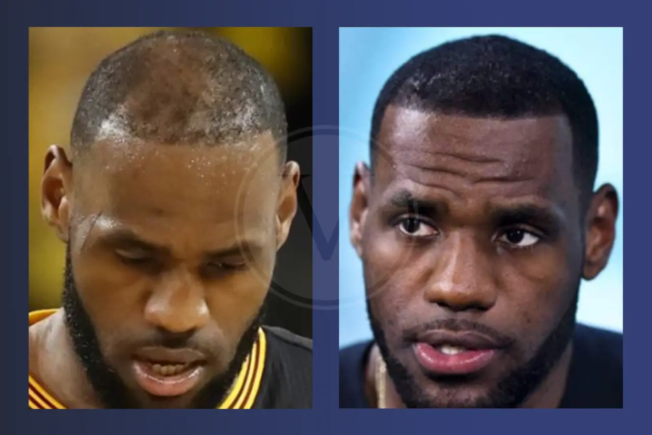LeBron James Before and After Hair Transplant