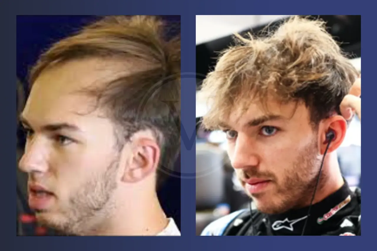 Pierre Gasly Before and After Hair Transplant