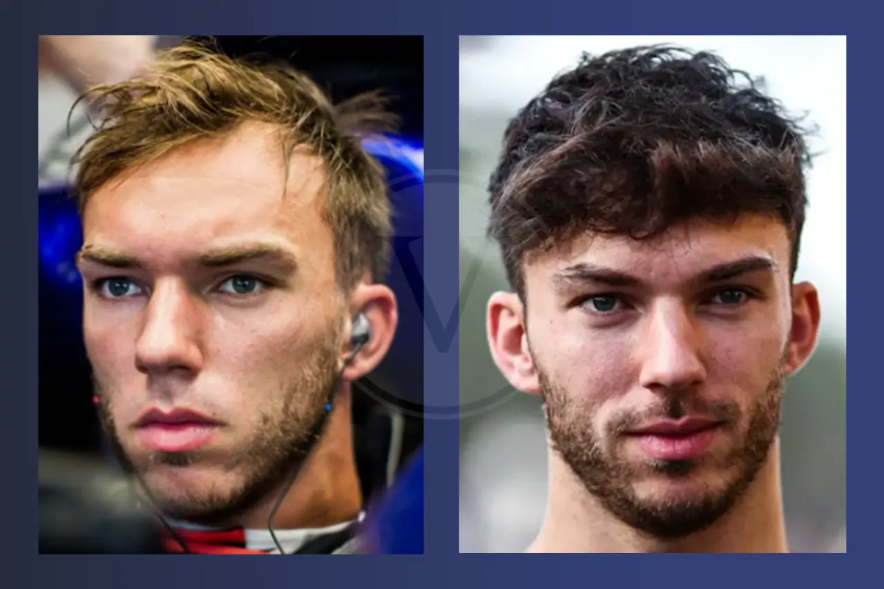 Pierre Gasly Before and After Hair Transplant