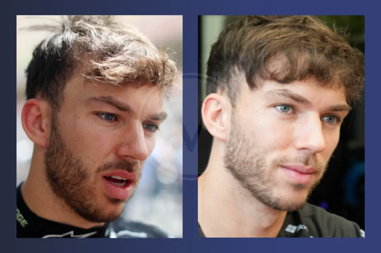 Pierre Gasly Before and After Hair Transplant