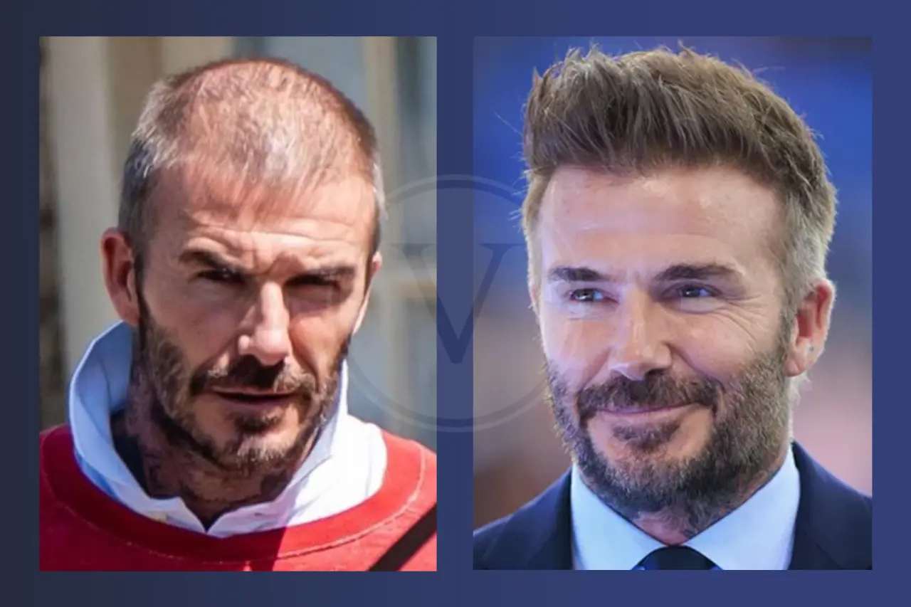 David Beckham Before And After Hair Transplant