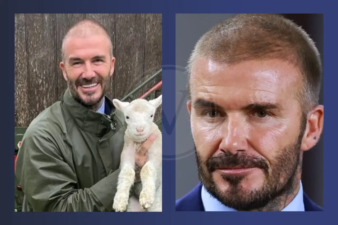 David Beckham Before And After Hair Transplant