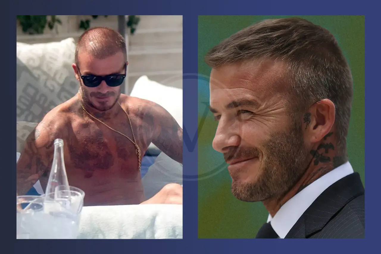 David Beckham Before And After Hair Transplant