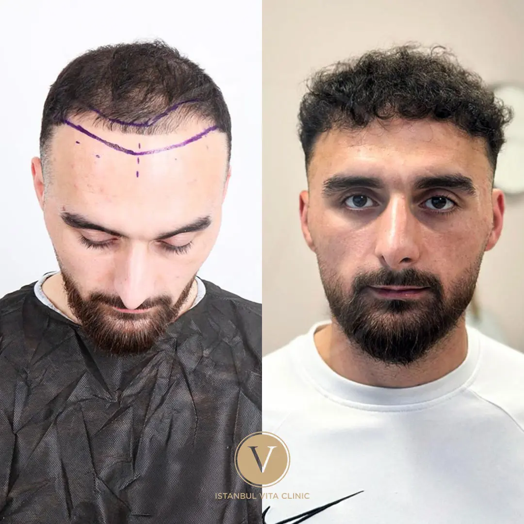Hair Transplant Before and After Results in Turkey