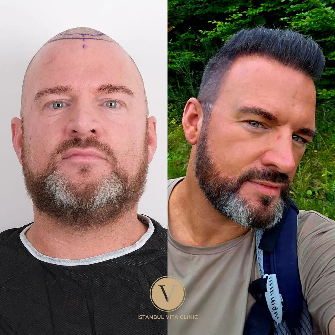 Hair Transplant Before and After Results in Turkey