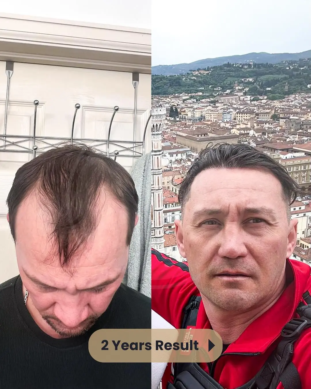 Hair Transplant Before and After Results in Turkey