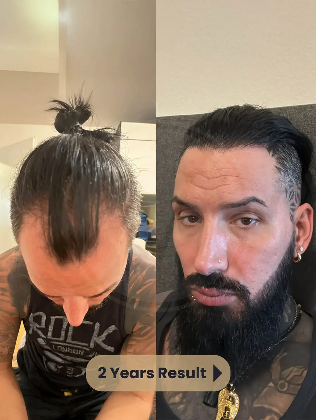 Hair Transplant Before and After Results in Turkey