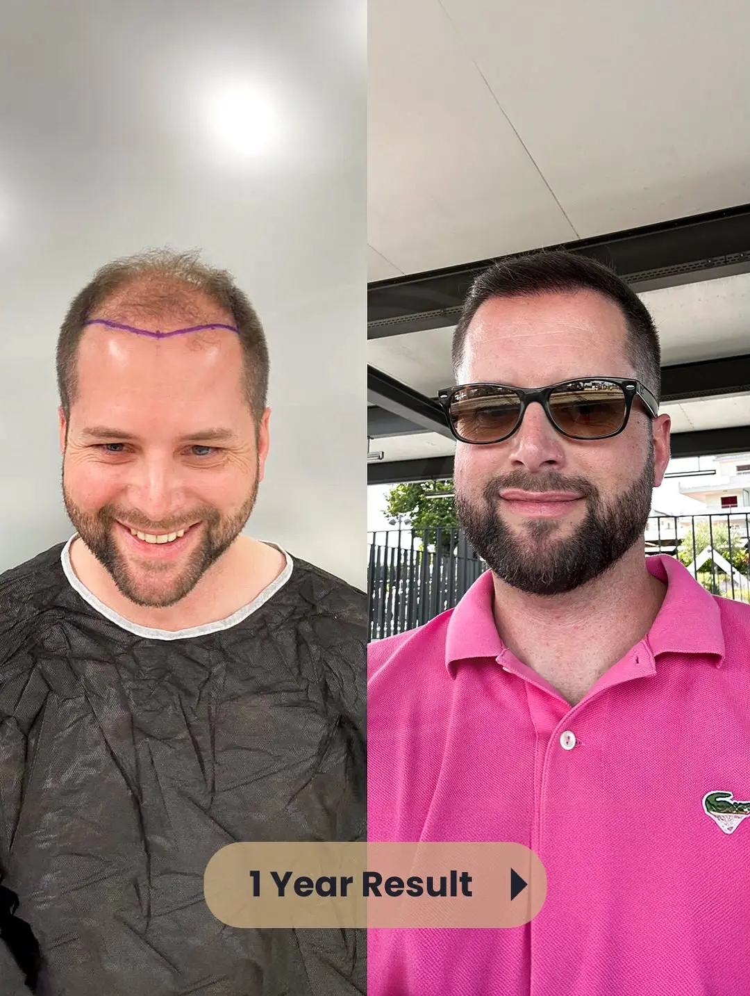 Hair Transplant Before and After Results in Turkey