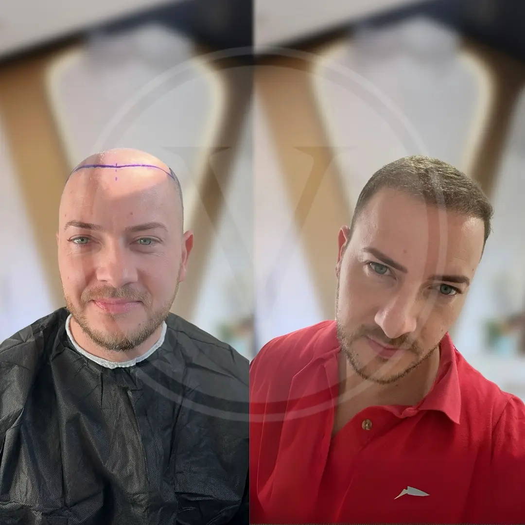 Hair Transplant Before and After Results in Turkey