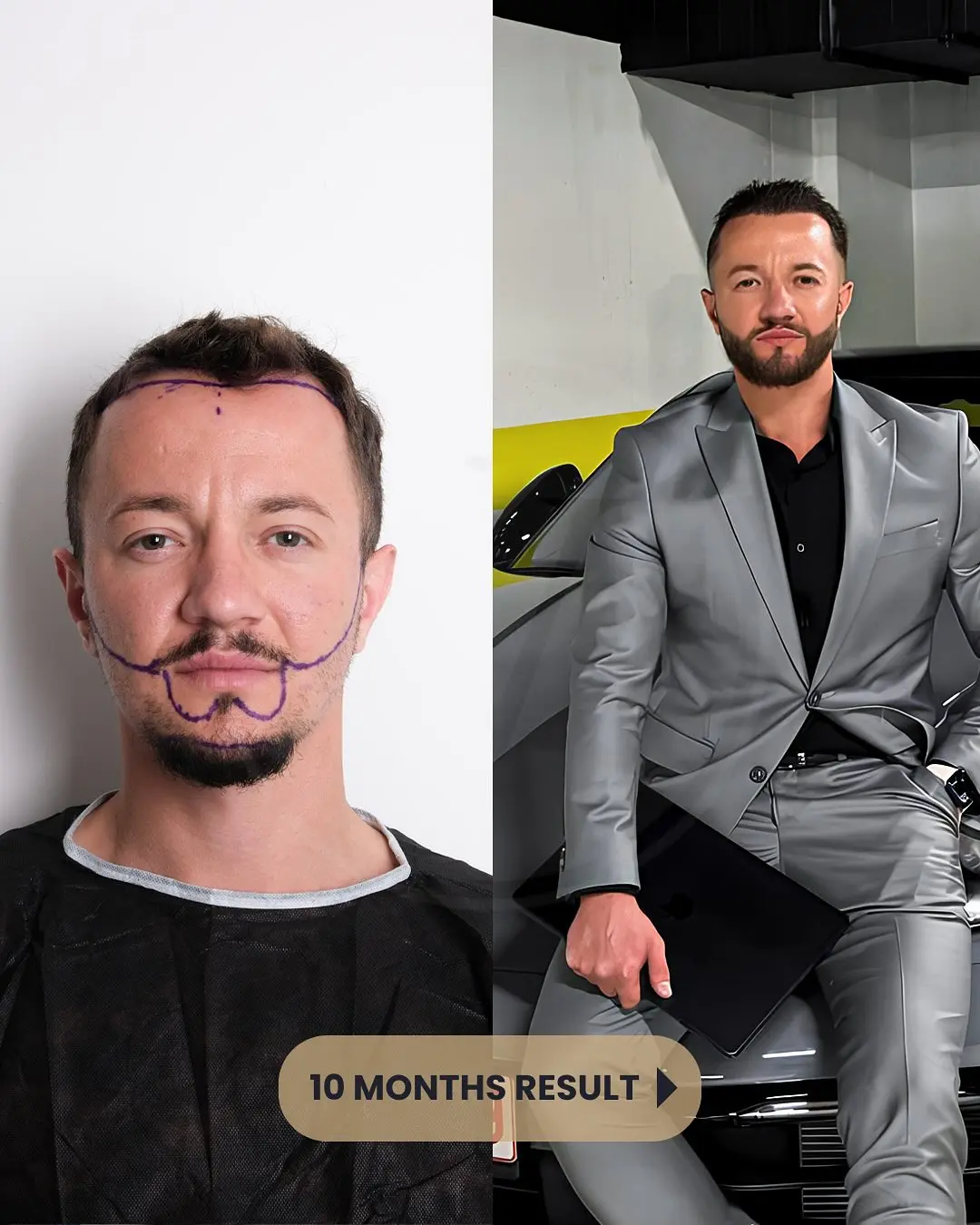 Hair Transplant Before and After Results in Turkey