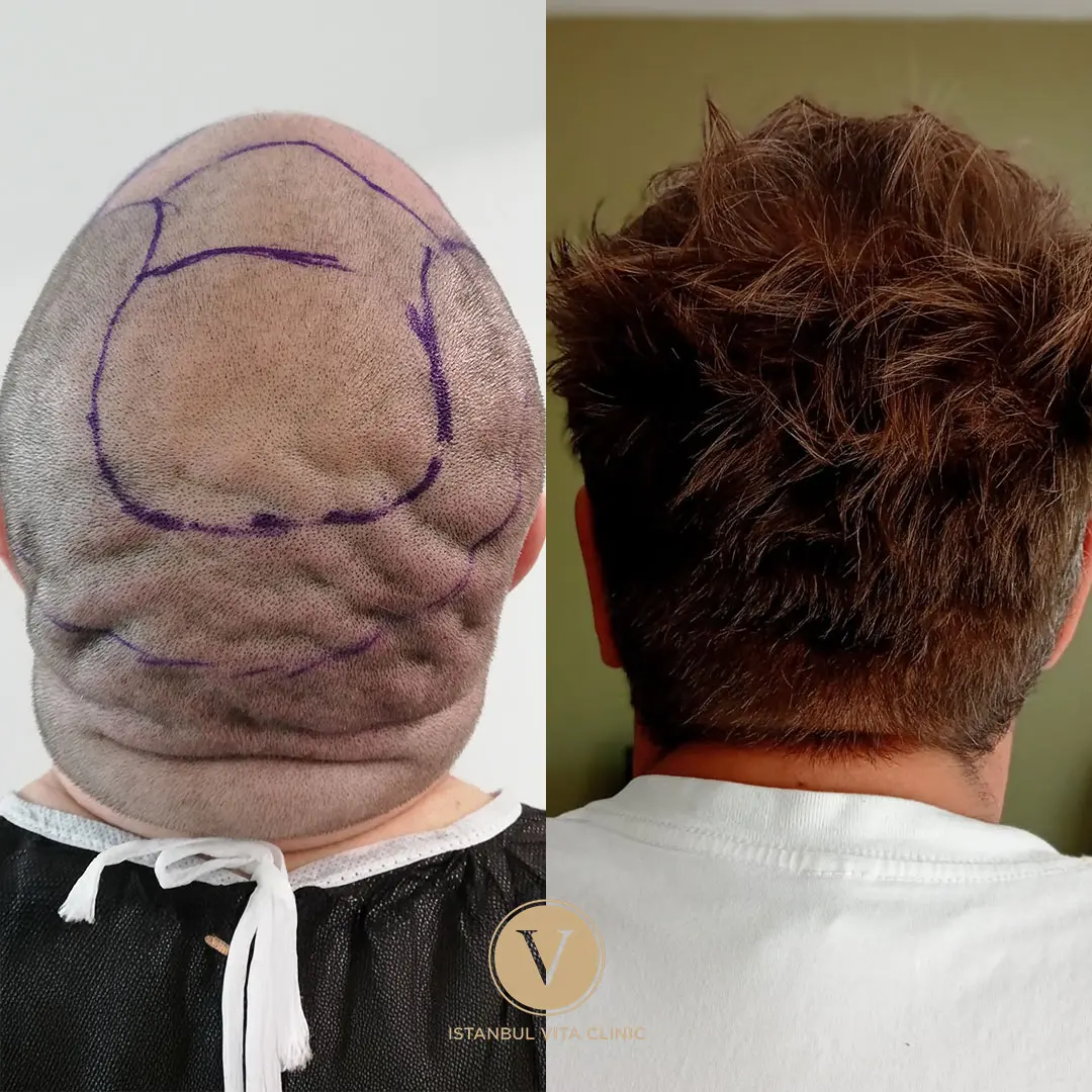 Hair Transplant Before and After Results in Turkey
