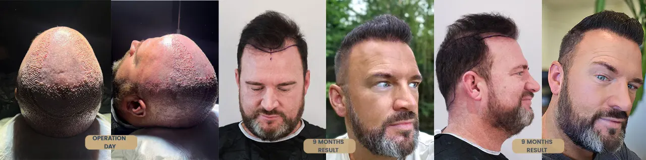 Hair Transplant Before and After Results in Turkey