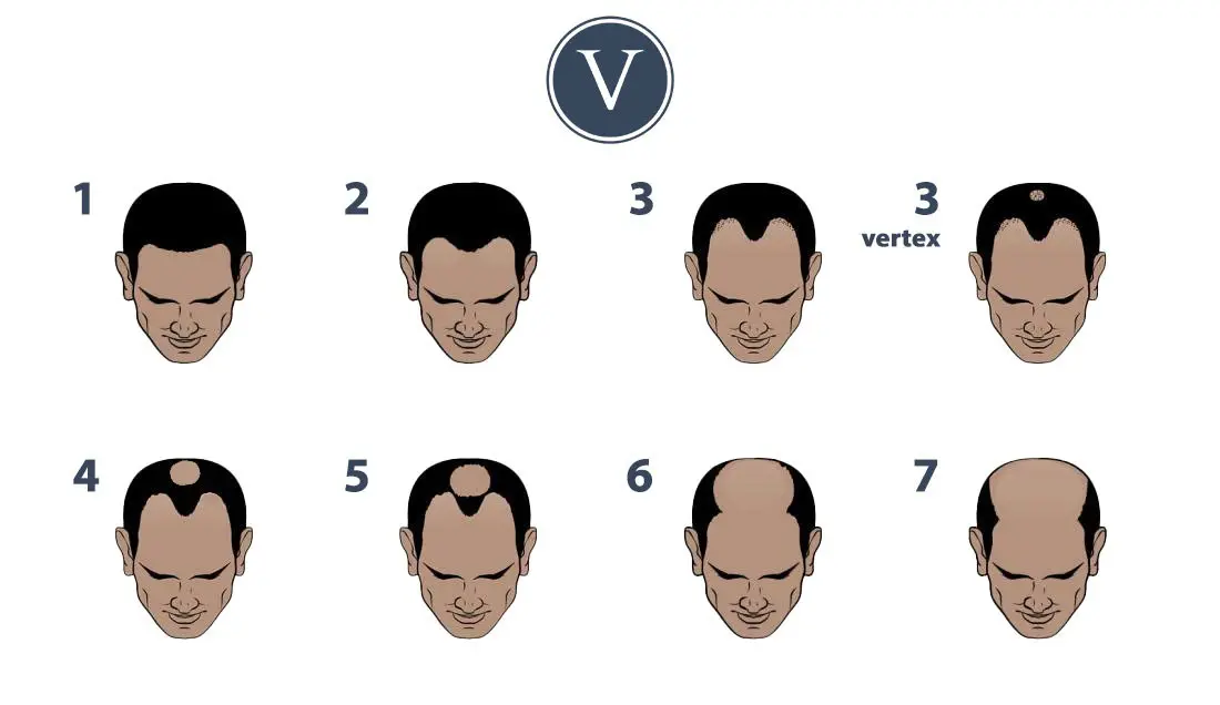 Hair Transplant Before and After Results in Turkey