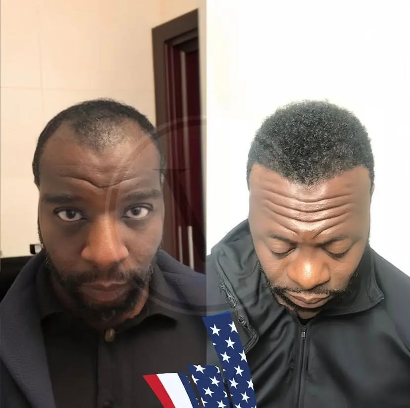 Before and After Afro Hair Transplant