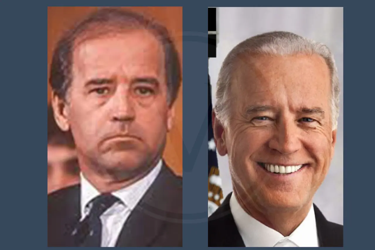 Joe Biden Before and After Hair Transplant