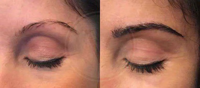 eyebrow transplant before and after