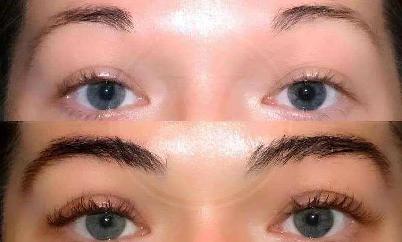 eyebrow transplant before and after