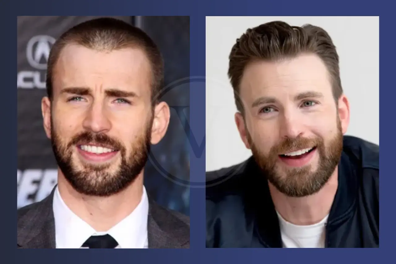Chris Evans Before and After Hair Transplant