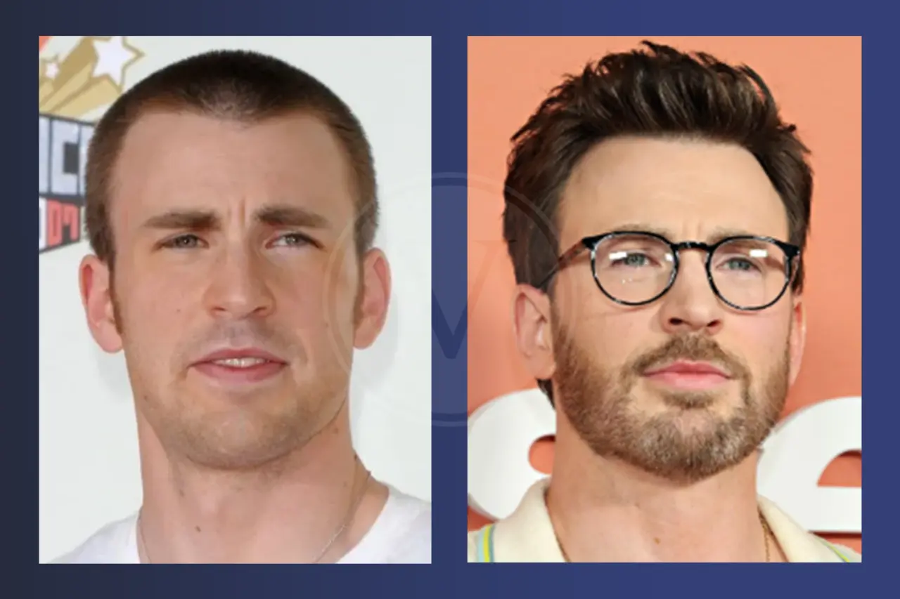 Chris Evans Before and After Hair Transplant