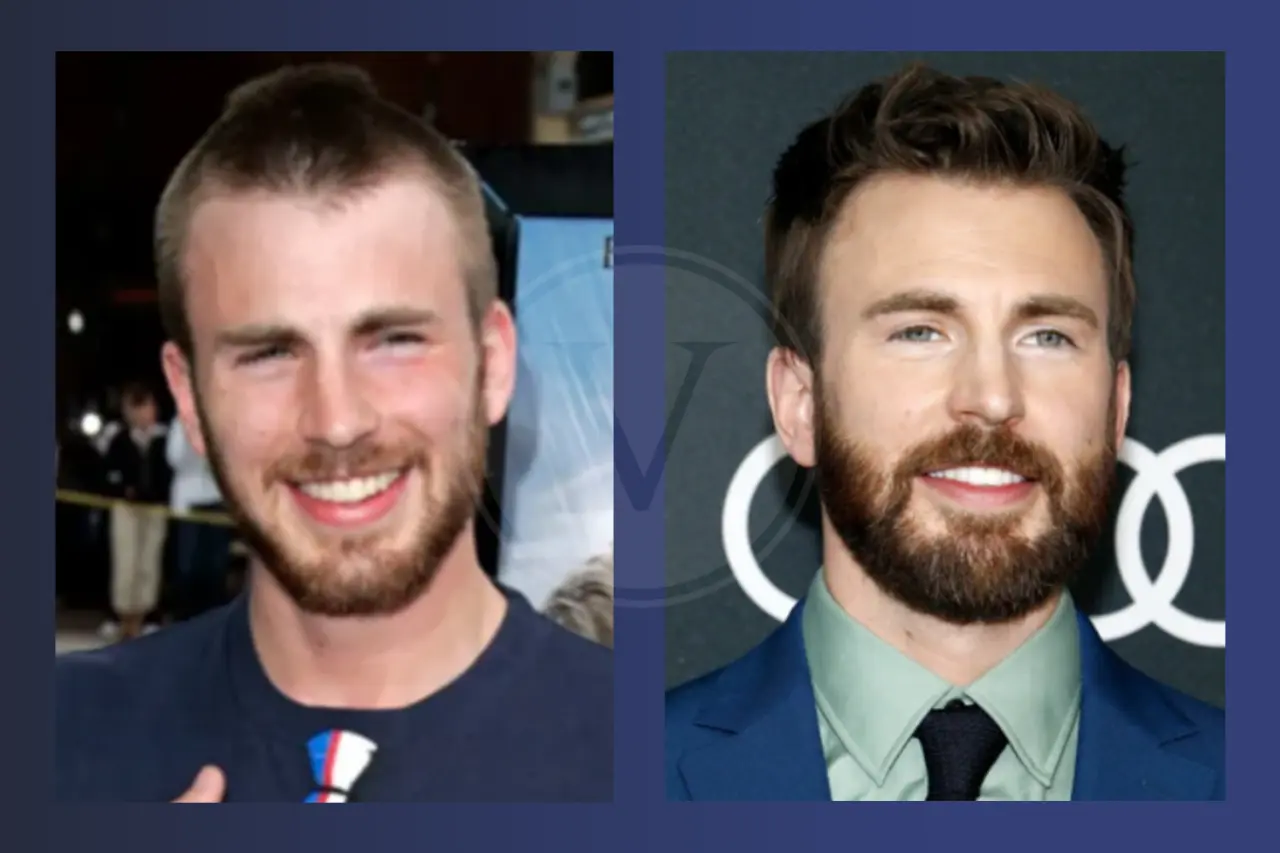 Chris Evans Before and After Hair Transplant
