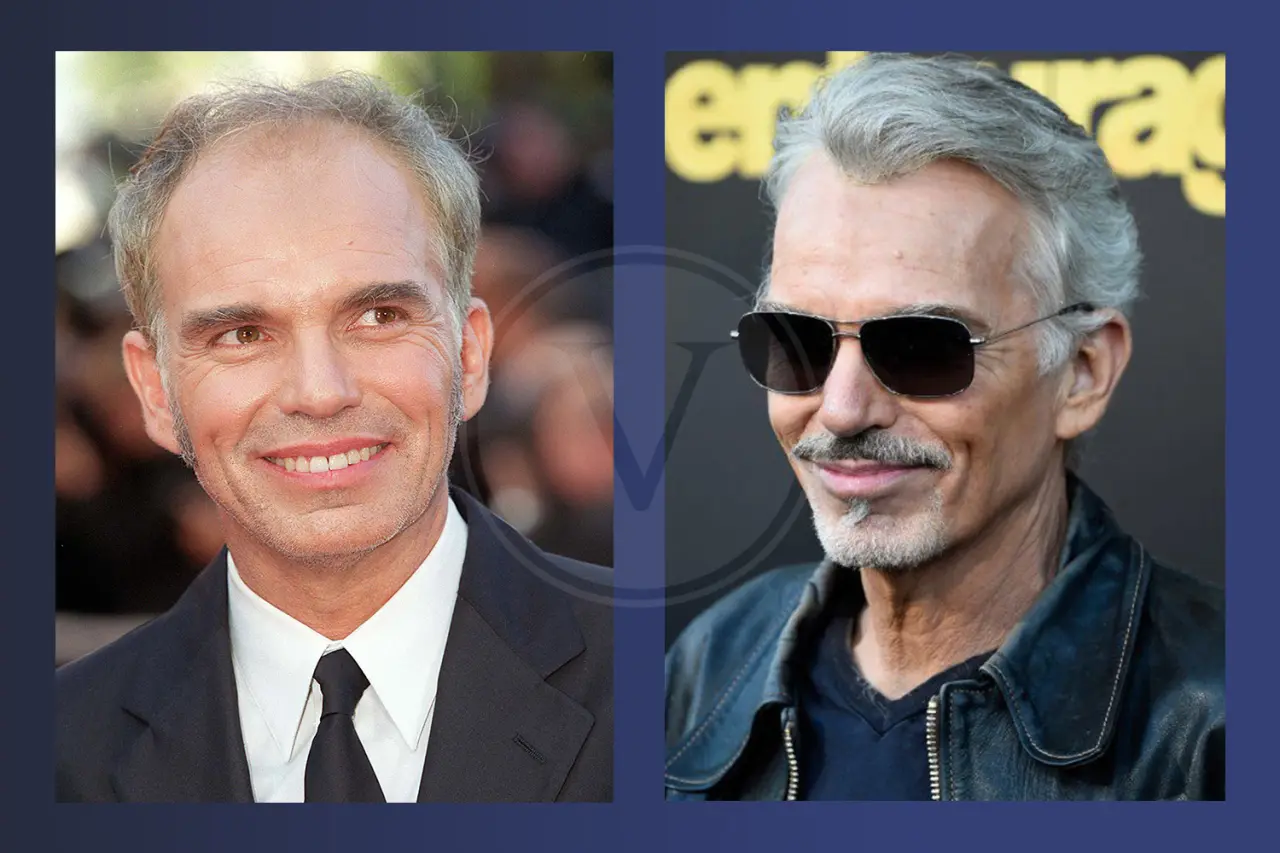Billy Bob Thornton Before and After Hair Transplant