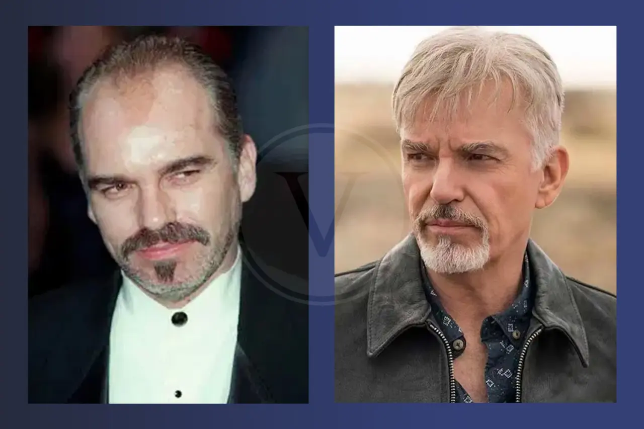 Billy Bob Thornton Before and After Hair Transplant