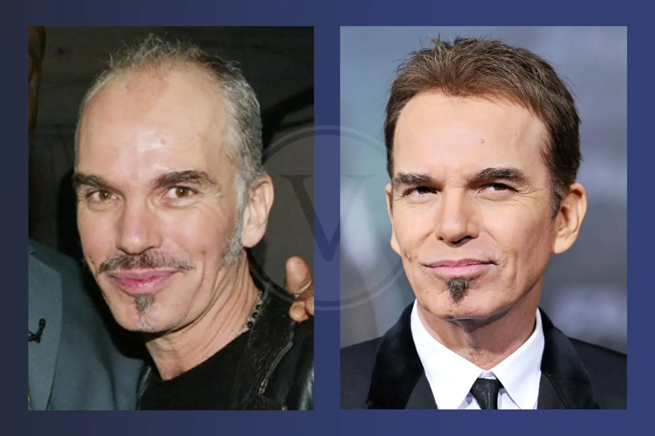 Billy Bob Thornton Before and After Hair Transplant