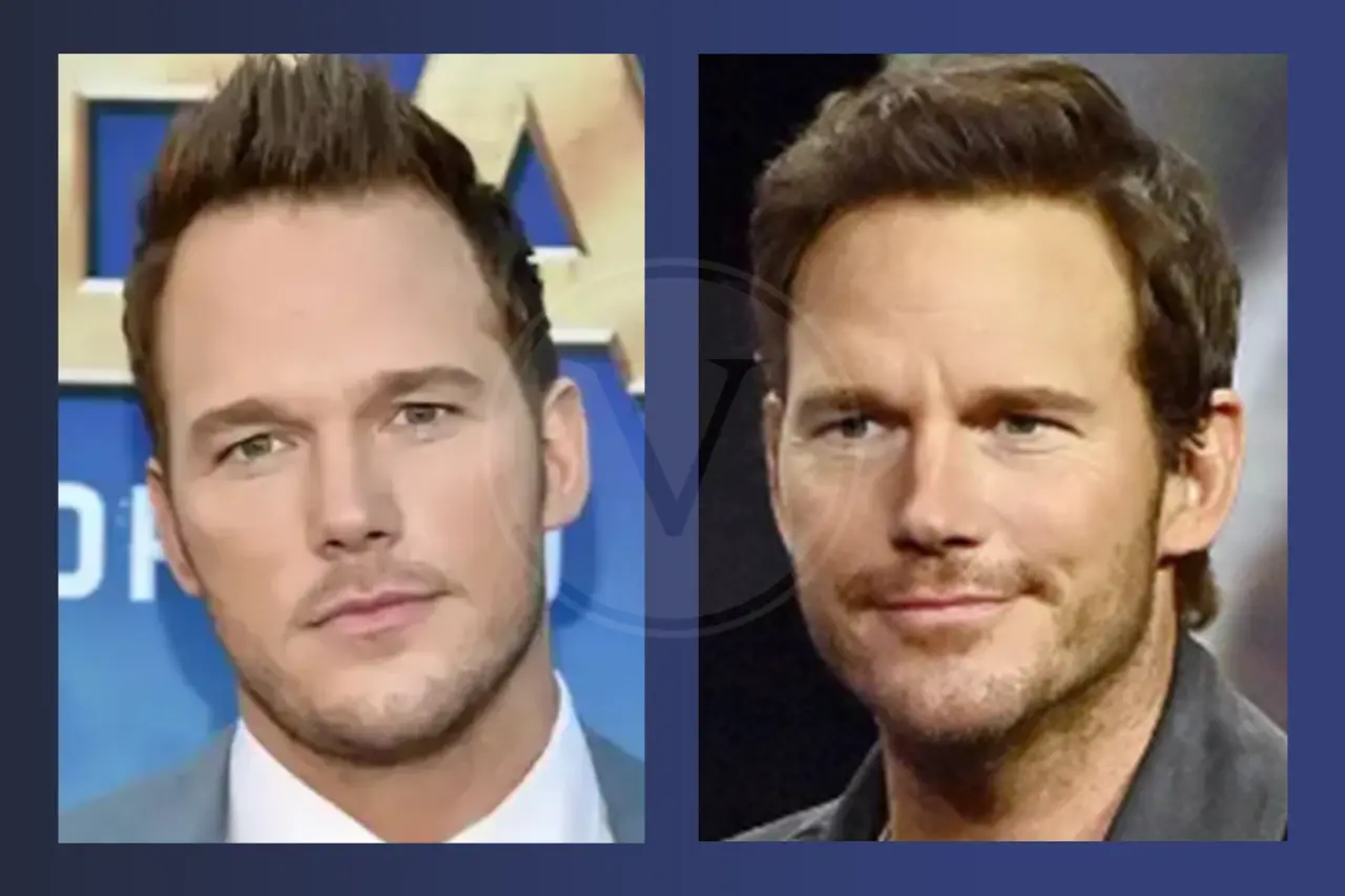 Chris Pratt Before and After Hair Transplant