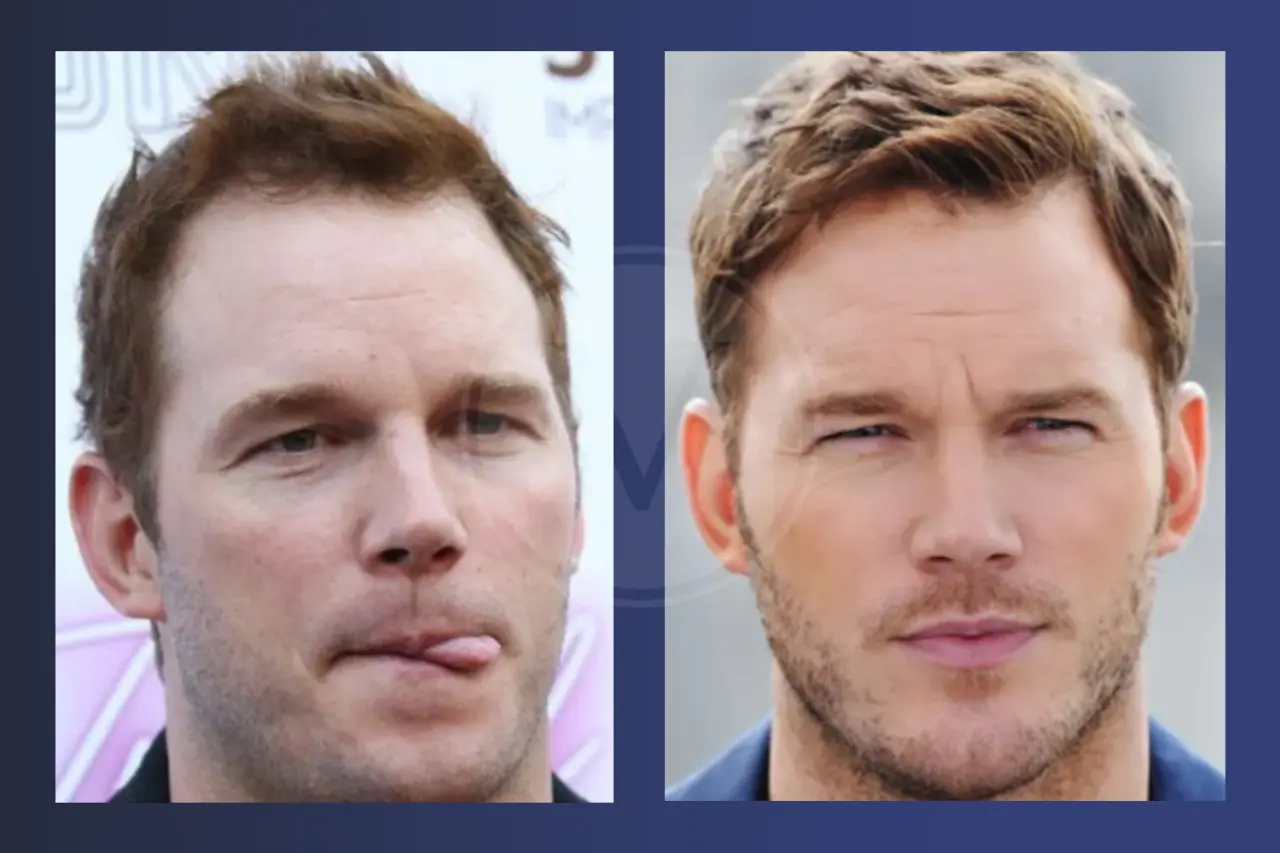 Chris Pratt Before and After Hair Transplant
