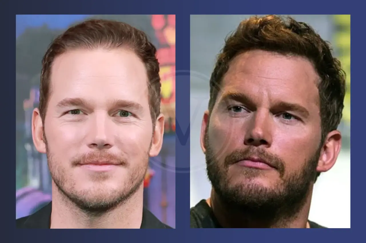 Chris Pratt Before and After Hair Transplant