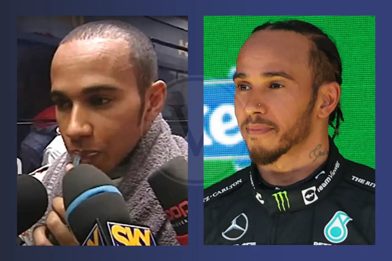 Lewis Hamilton Before and After Hair Transplant