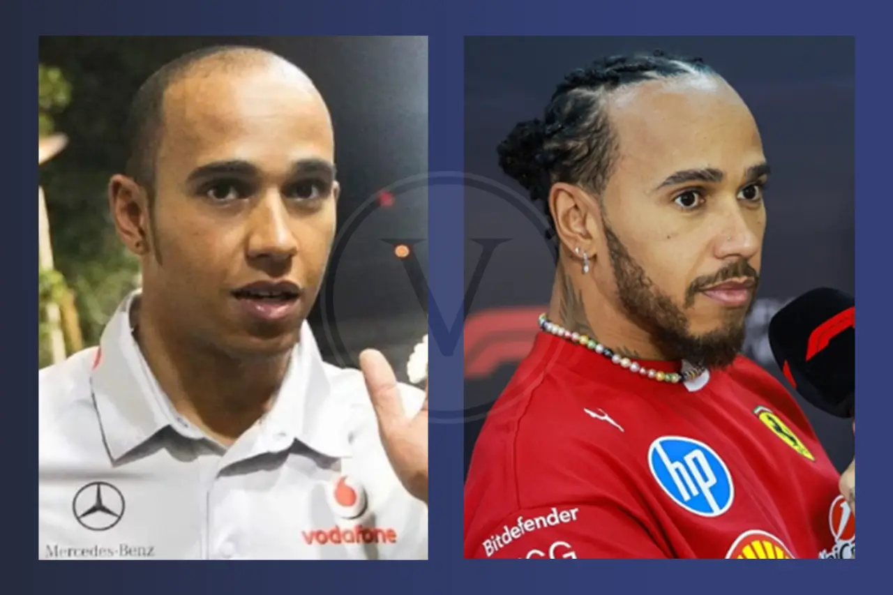 Lewis Hamilton Before and After Hair Transplant