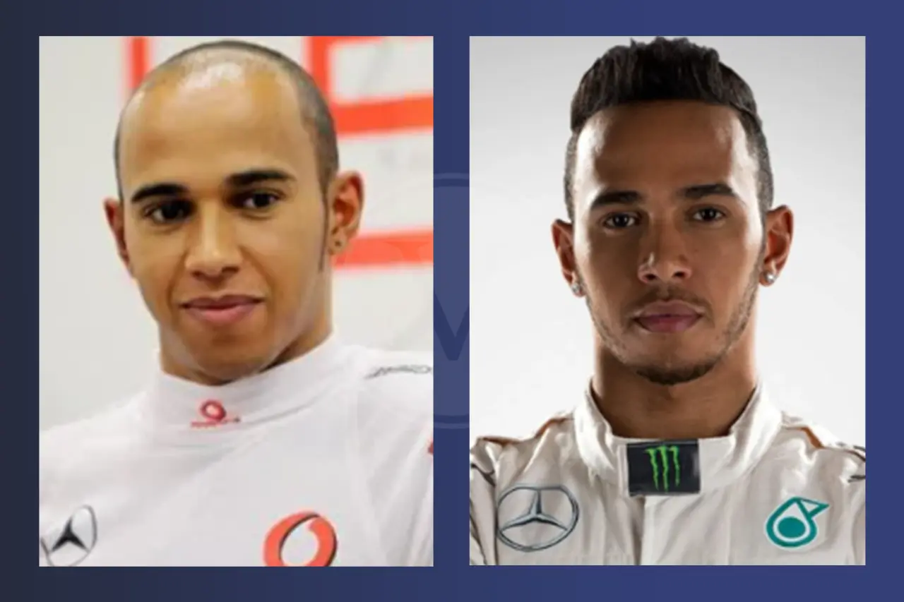 Lewis Hamilton Before and After Hair Transplant