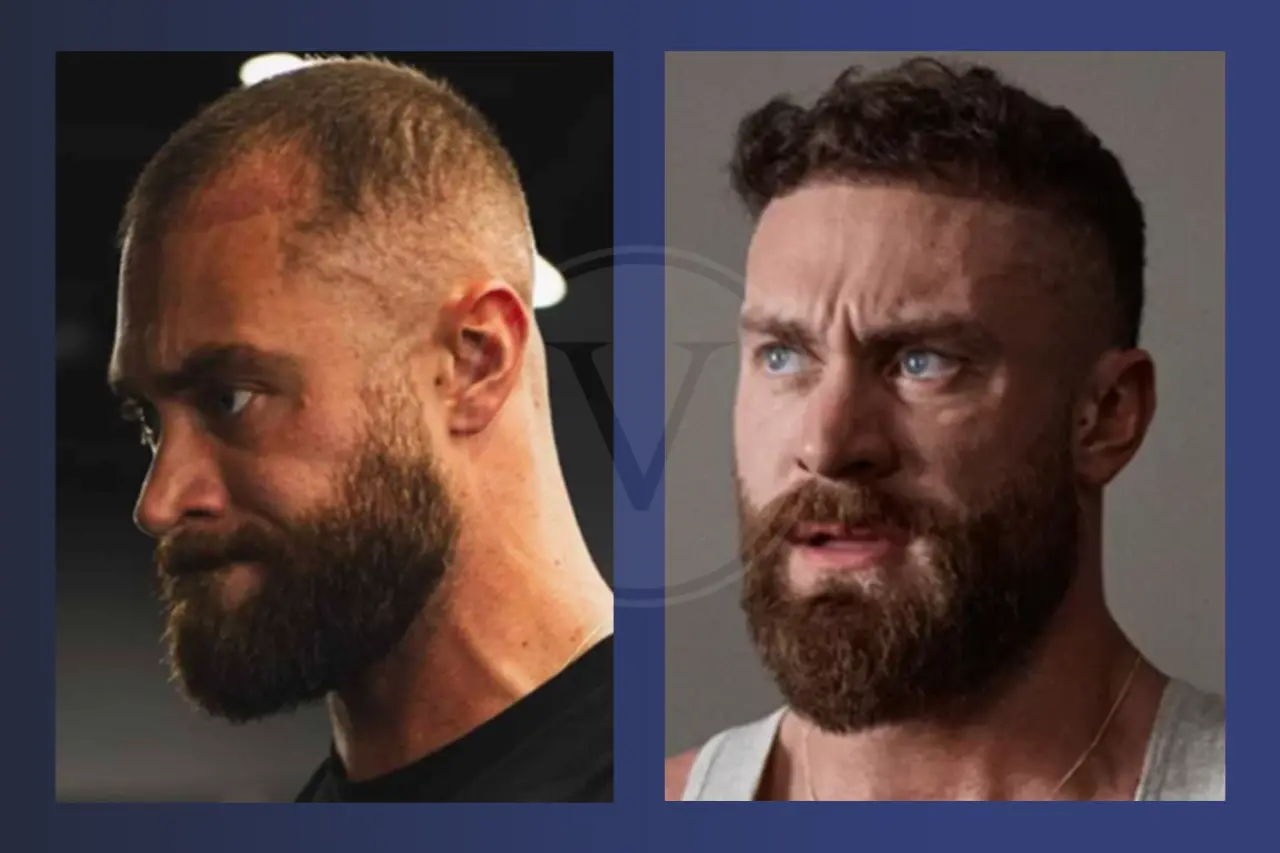 Chris Bumstead Before and After Hair Transplant