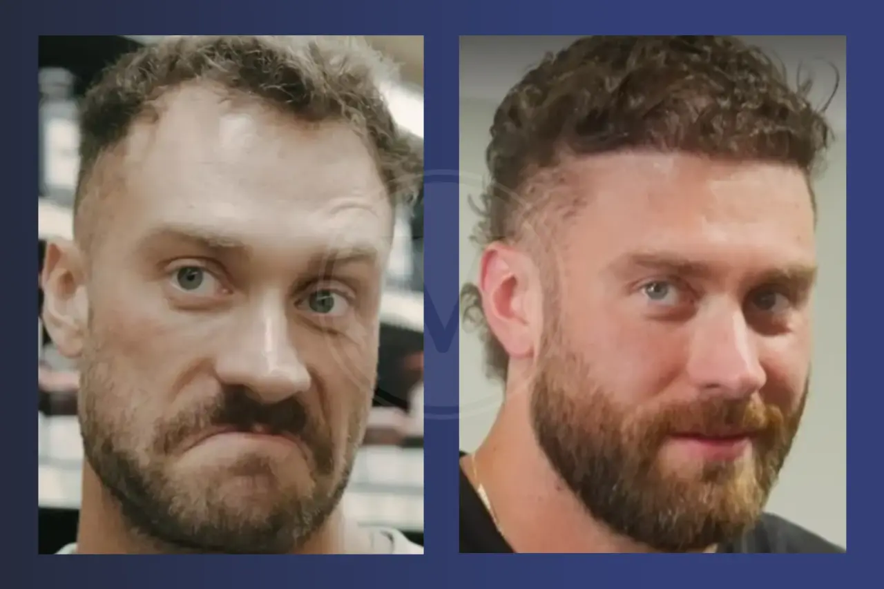 Chris Bumstead Before and After Hair Transplant