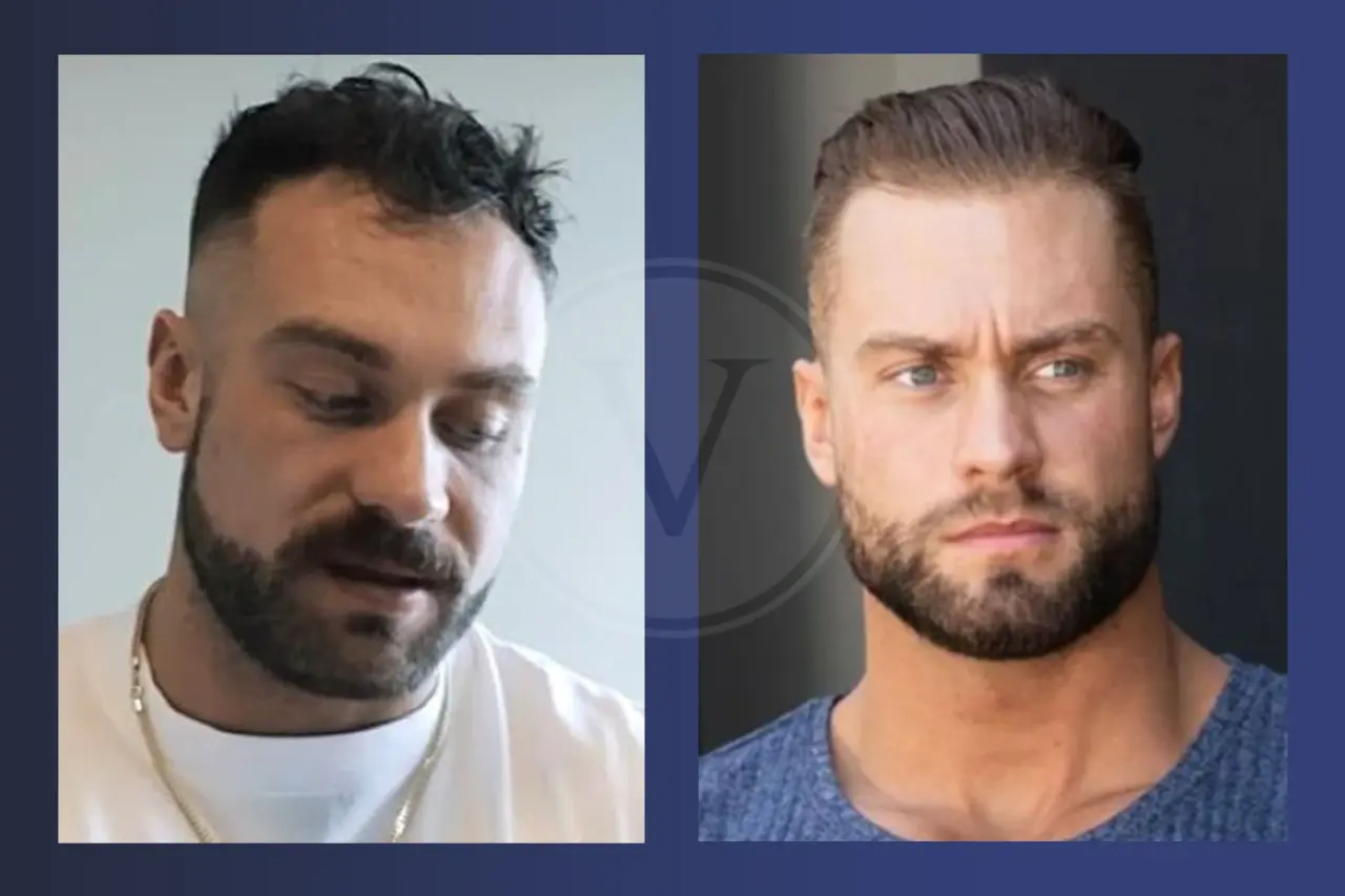 Chris Bumstead Before and After Hair Transplant