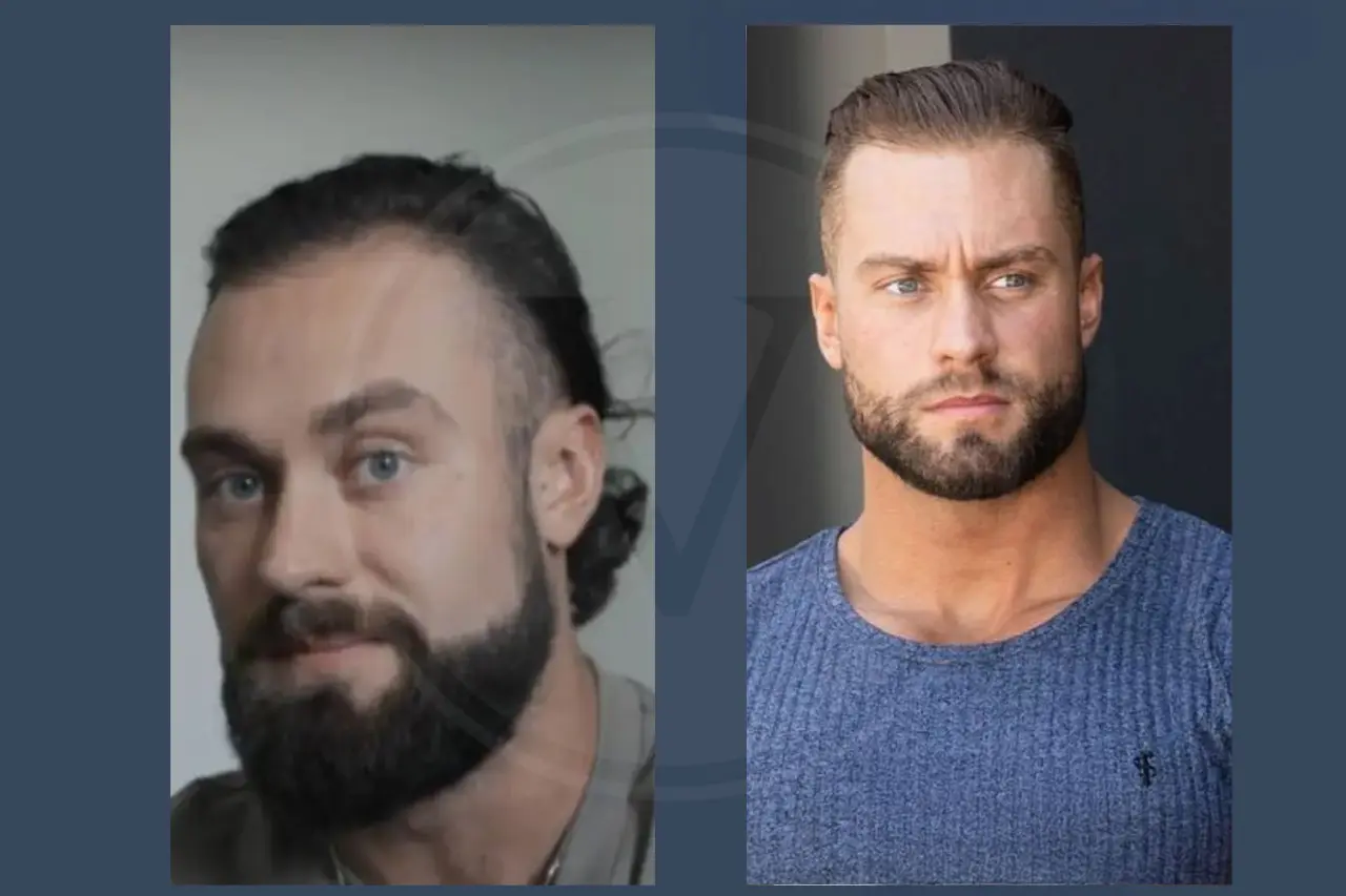 Celebrity Hair Transplant Chris Bumstead