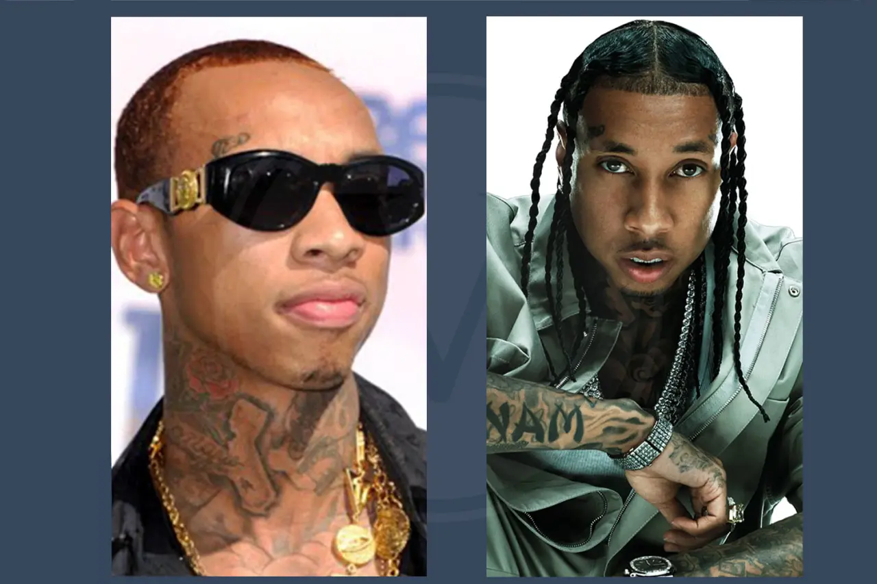 Tyga Before and After Hair Transplant