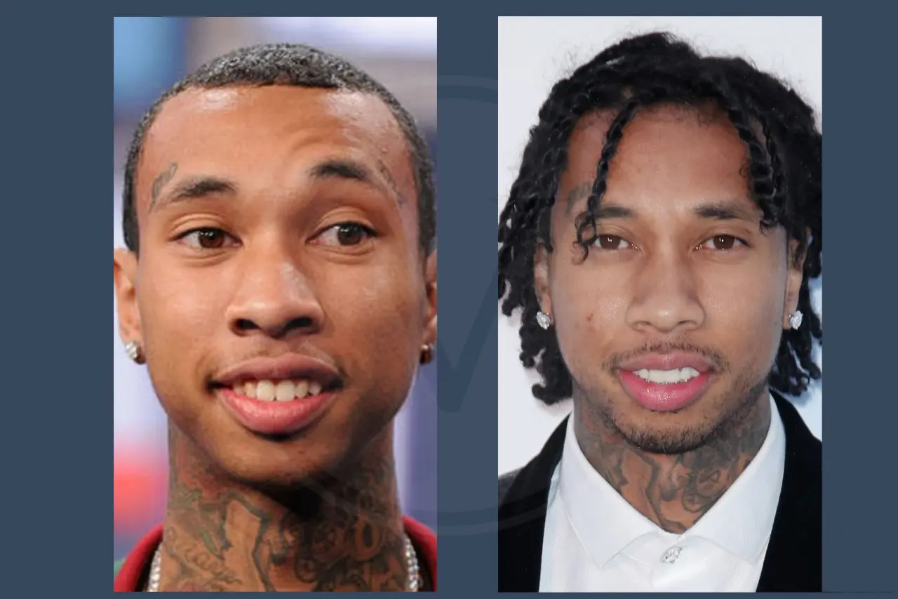 Tyga Before and After Hair Transplant