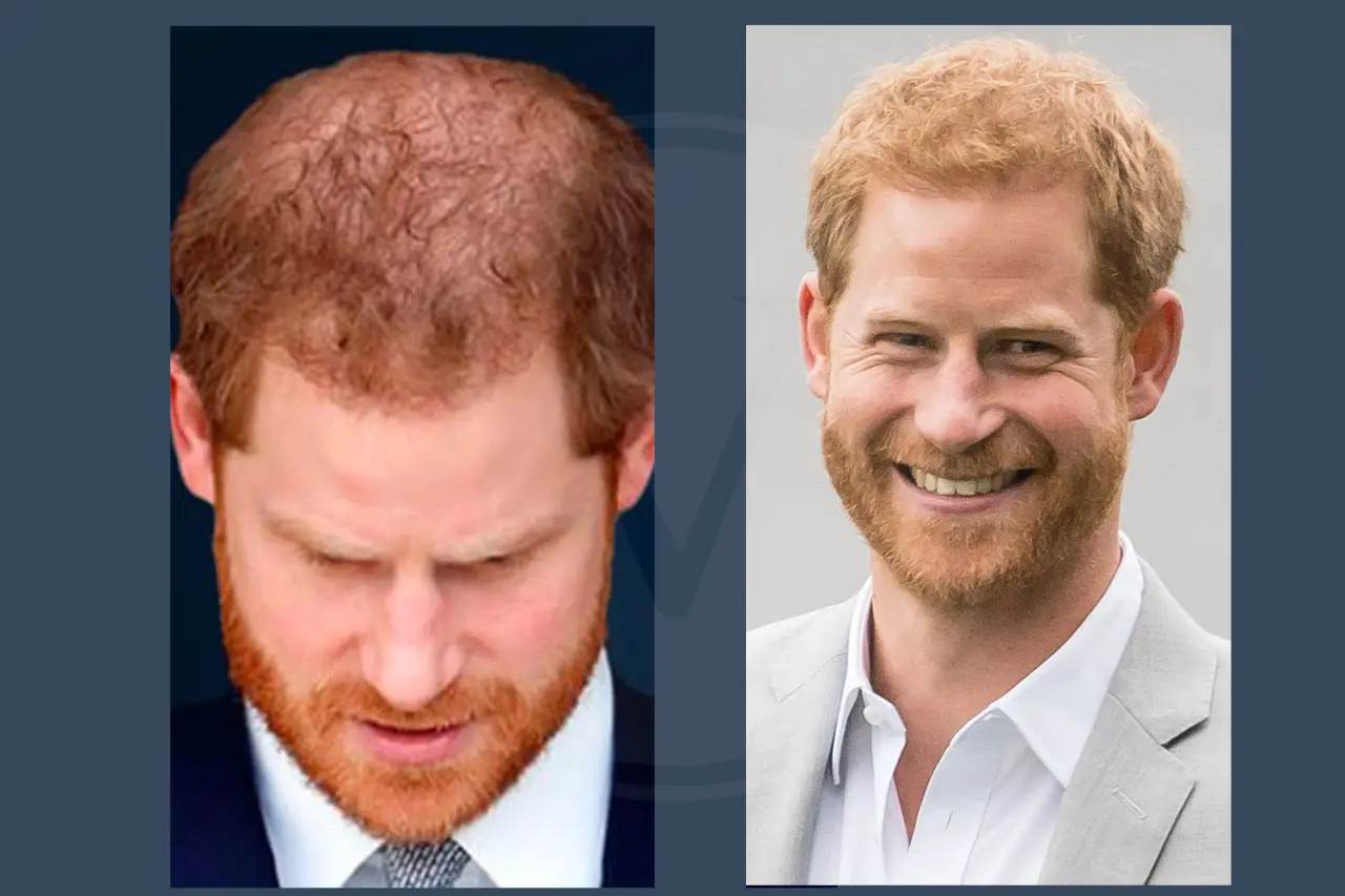 Prince Harry Hair Transplant Before and After