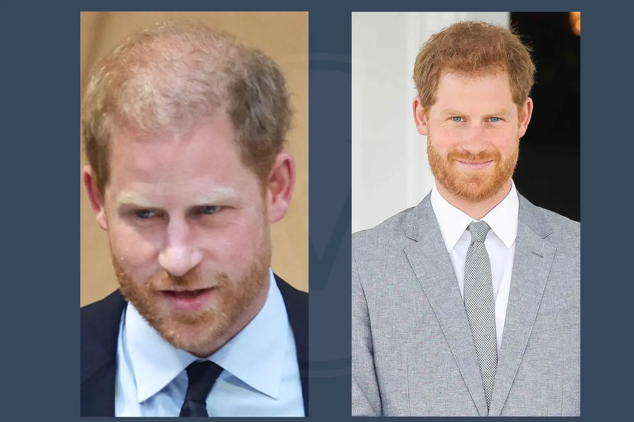 Prince Harry Hair Transplant Before and After